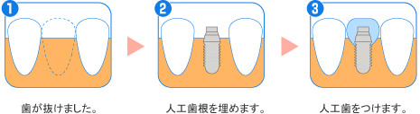 インプラントの治療の流れ