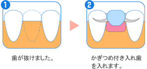 入れ歯治療箇所の画像