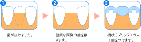 ブリッジ施術の流れ