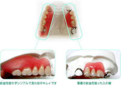 入れ歯